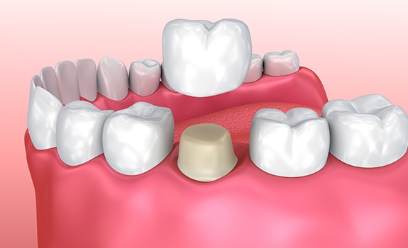 Animated porcelain dental crown palcement