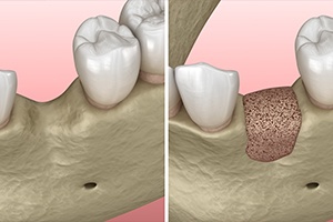 Animated smile before and after bone grafting