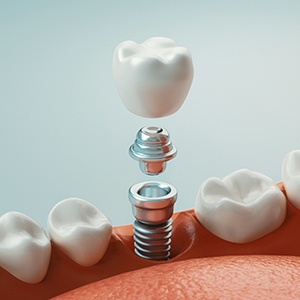 diagram of the parts of a dental implant 