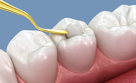 a 3D illustration showing a tooth being restored