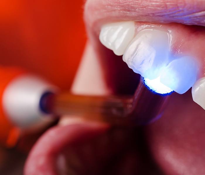 Dental light hardening bonding material 