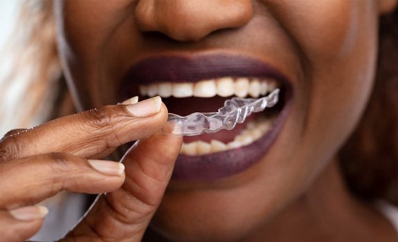Closeup of woman placing top aligners in her mouth