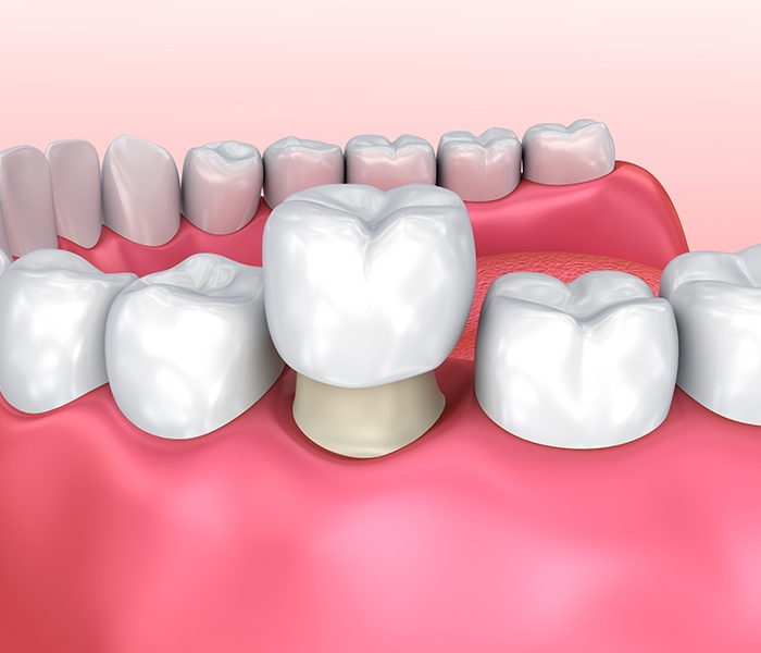 Animated dental crown placement