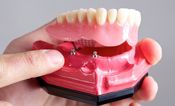 Model of dental implant over denture