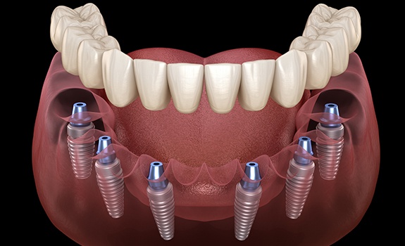 Animated dental implant supported denture