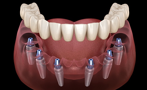 Aniamted dental implant supported denture