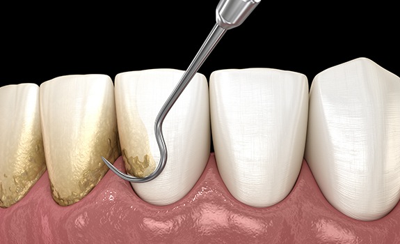 Animated smile during scaling and root planing treatment