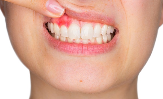 Closeup of inflamed gum tissue before periodontal disease treatment