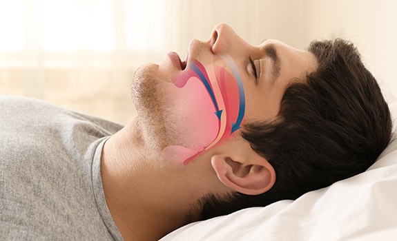 Man with sleep apnea with animation of obstructed airway over his profile
