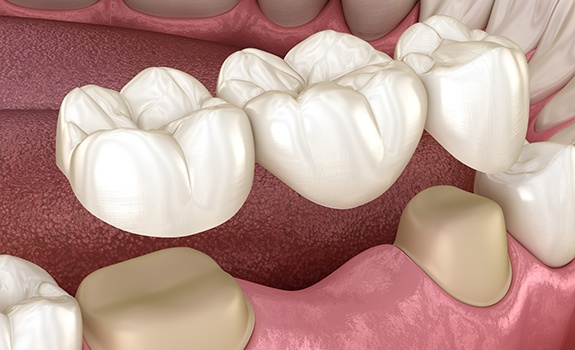 Animated dental bridge placement