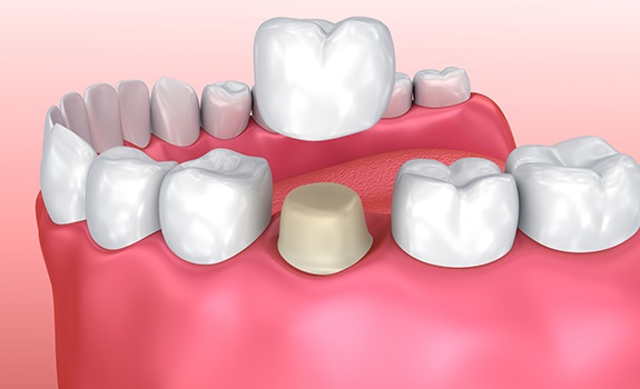 Animated dental crown placement