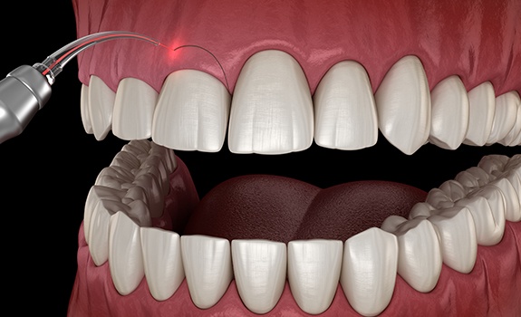 Animated smile during gum recontouring treatment