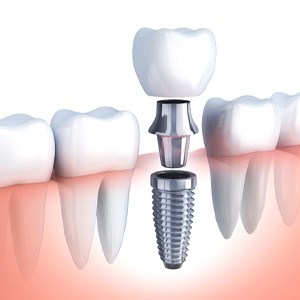 Dental implant in Rowley