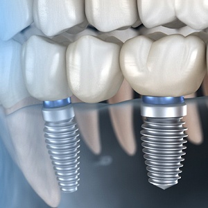 Implant bridge in Rowley