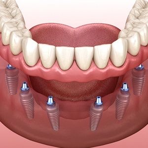 Implant denture in Rowley