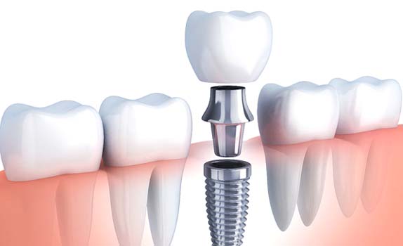 Digital illustration of dental implants in Rowley