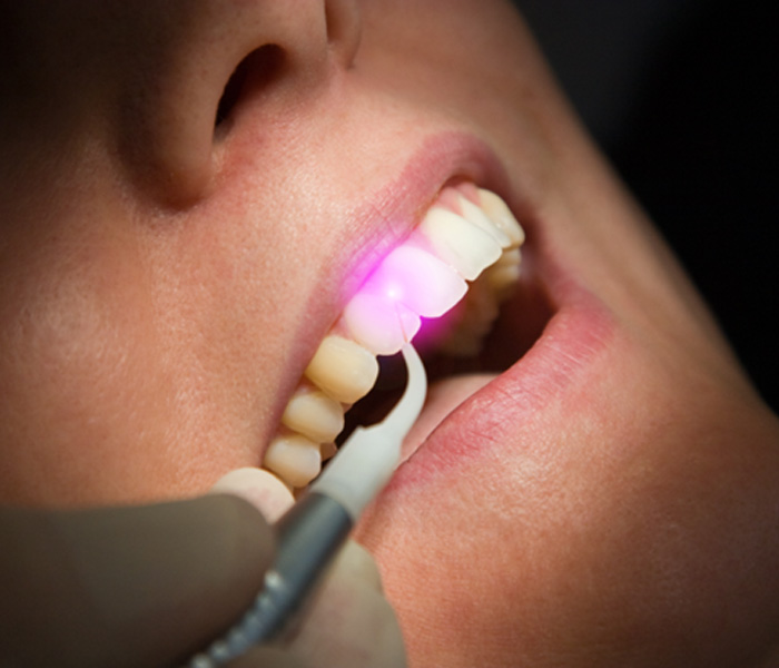 a dentist using a dental laser