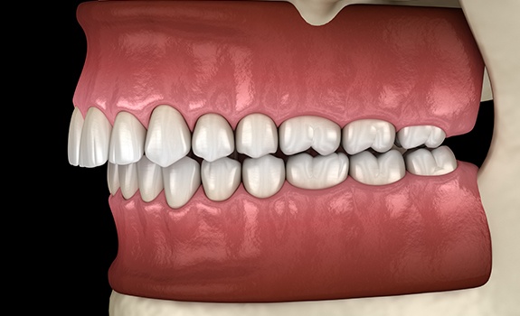 Animated smile before occlusal equilibration