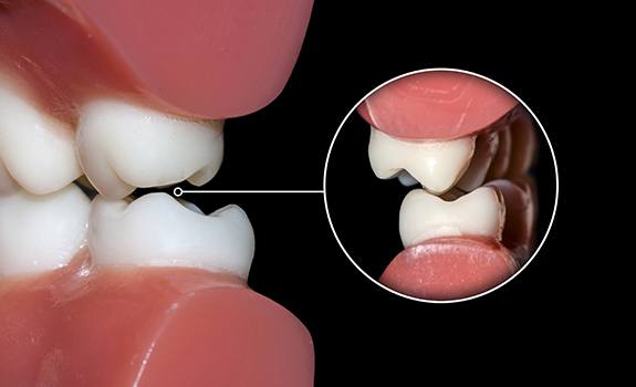 Closeup of smile in needof occlusal equilibration