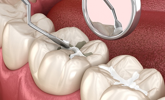 Animated smile during tooth colored filling treatment