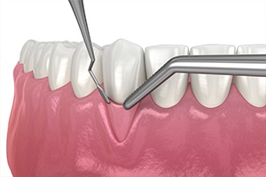 Animated smile during soft tissue grafting procedure