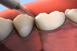 Aniamted smile during topical antibiotic treatment