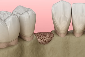 Animated smile after ridge augmentation