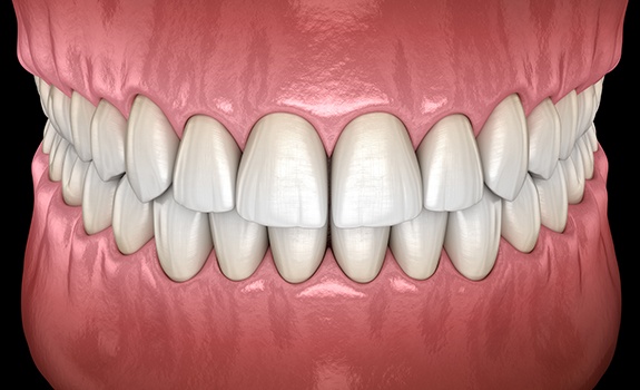 Animated smile after basic periodontal treatment