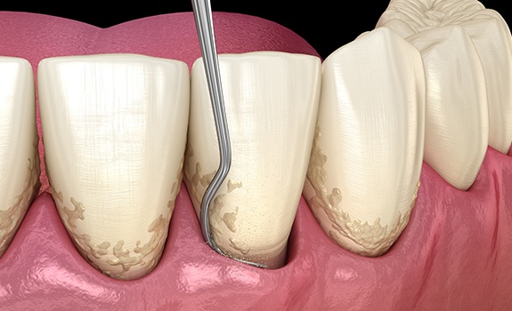 Aniamted smile during upper level infection removal