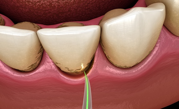 Animated smile during lower level infection removal