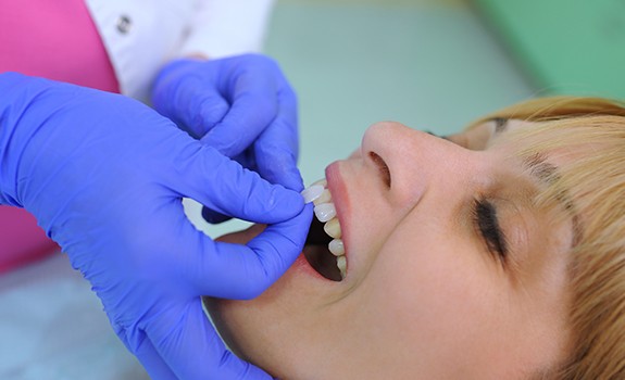 Dentist showing patient porcelain veneer options